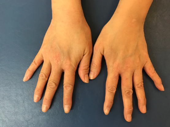 手の湿疹 Yさん６